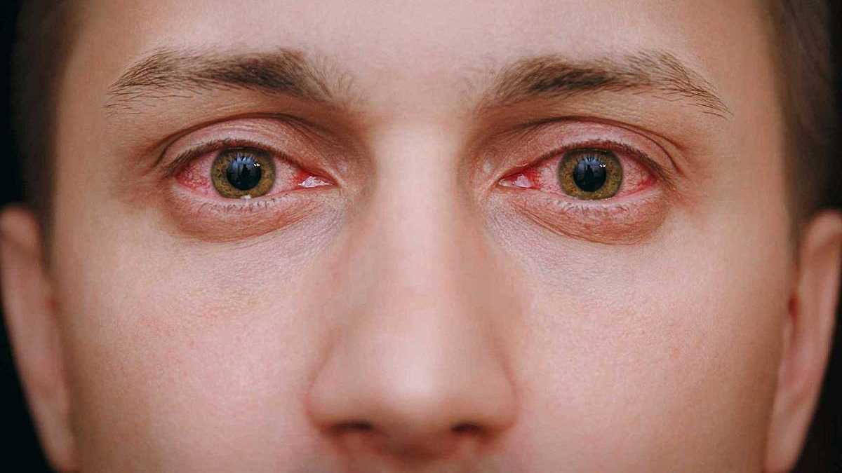Close-up image of a man's red eyes after smoking weed