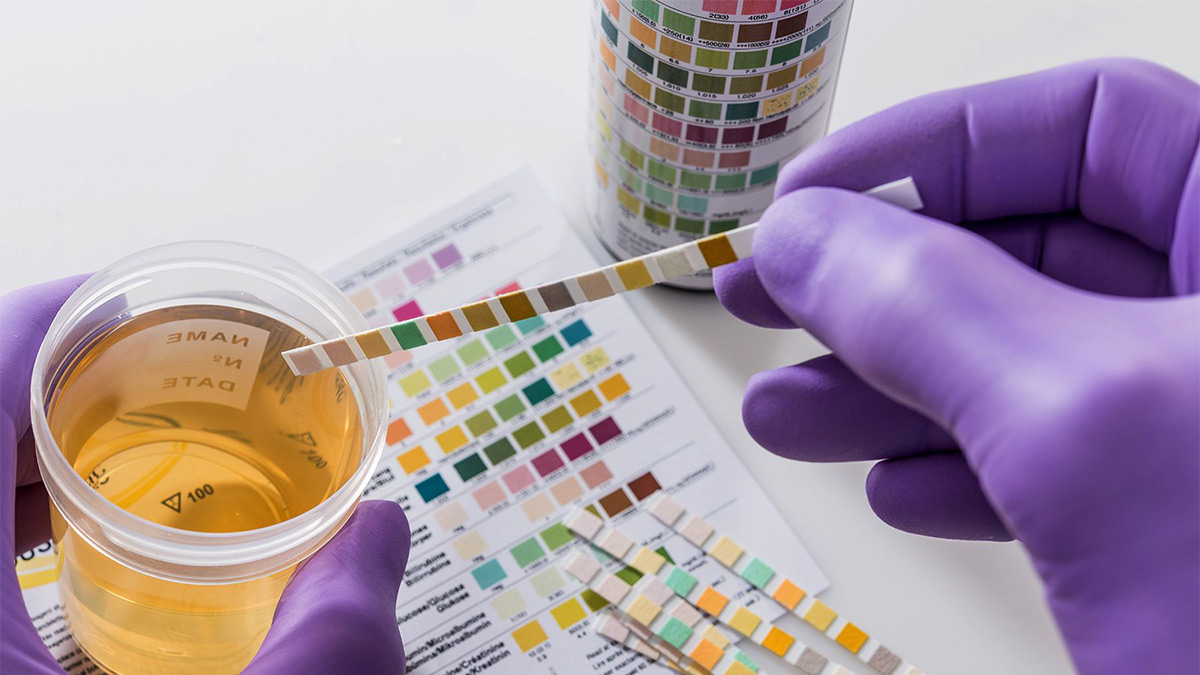 Image of a Urine Drug Test for THC