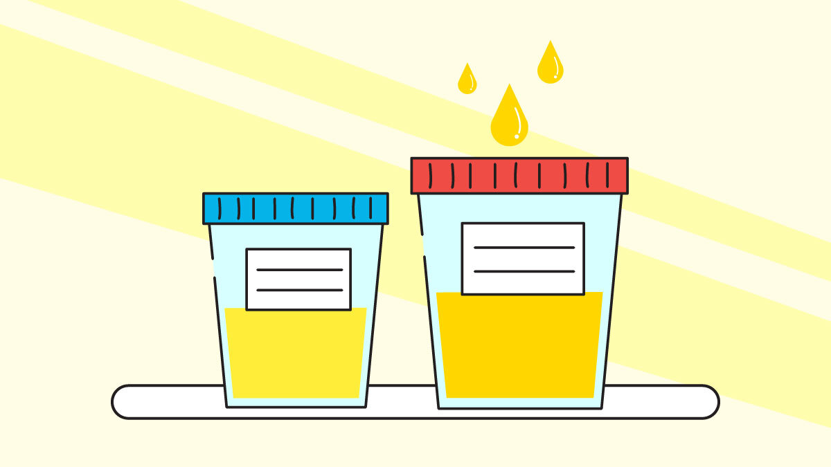 Illustration of Urine test for THC Metabolites